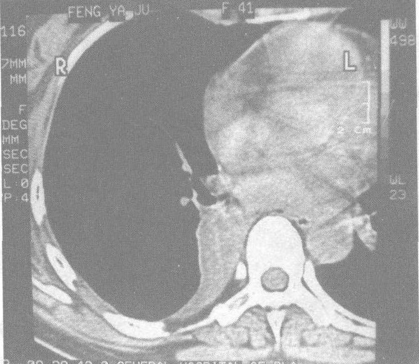 病例2 中央型典型支气管类癌